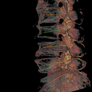CT-categories-interventional-x-ray-igs-for-hybrid-or-discovery igs 730-nadelassistent-3.jpg