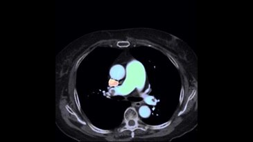 Vorbehandlung: Thrombose-Bild (Zeff)