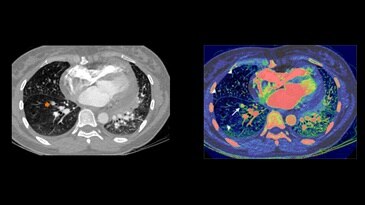 Lungenembolie und Perfusionsstörung