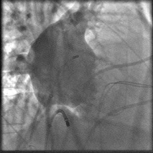product-product-categories-interventional-x-ray-igs-for-ep-plan-ep-ablation.jpg