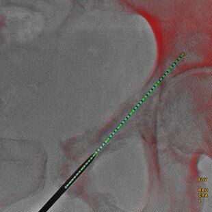 product-product-categories-Interventional - 2016-needle_22.jpg