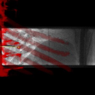 product-product-categories-Interventional - 2016-needle_32.jpg