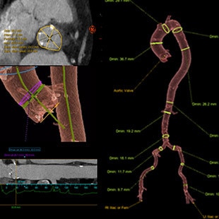 product-product-categories-Interventional - 2016-valve_11.jpg