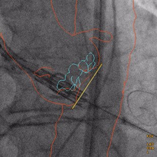 product-product-categories-Interventional - 2016-valve_12.jpg
