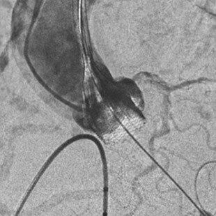 product-product-categories-Interventional - 2016-valve_13.jpg