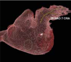 product-product-categories-Interventional - 2016-valve_21.jpg