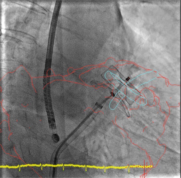 product-product-categories-Interventional - 2016-valve_22.jpg