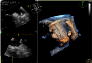 product-product-categories-Interventional - 2016-valve_23.jpg