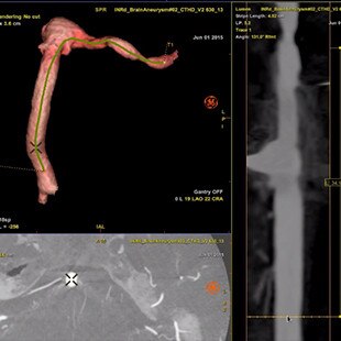 product-product-categories-Interventional - 2016-vessel_21.jpg