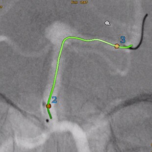 product-product-categories-Interventional - 2016-vessel_22.jpg