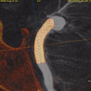 product-product-categories-Interventional - 2016-vessel_23.jpg