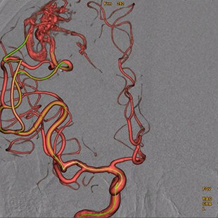 product-product-categories-Interventional - 2016-vessel_32.jpg