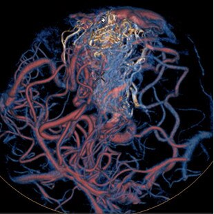product-product-categories-Interventional - 2016-vessel_33.jpg